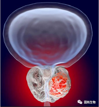 前列腺癌新藥！基肽酶抑制劑talabostat聯(lián)合Keytruda在腺癌表型晚期難治性mCRPC療效令人鼓舞!